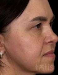 Результати Facetem S 1,5 ml  фото после #2