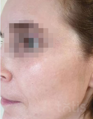 Результати 01 Me Line Caucasian Skin  фото после #2