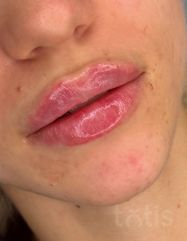 Результати Saypha Filler Lidocaine NEW  фото после #2