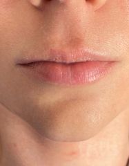 Результати Saypha Filler Lidocaine NEW  фото до #1