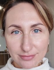 Результаты Lactic Astringent Prepping Agent  фото до #1