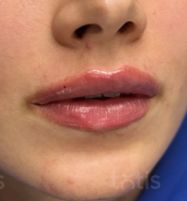 Результаты Saypha Filler Lidocaine NEW  фото после #2