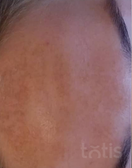Результати 01 Me Line Caucasian Skin  фото до #1