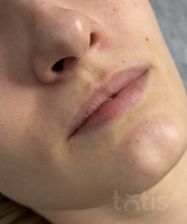 Результаты Saypha Filler Lidocaine NEW  фото до #1