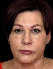 Výsledky Facetem S 0.8mlx2  фото до #1