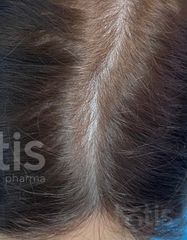 Результати Plinest Hair  фото после #2