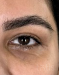 Результати PolyPhil eye  фото до #1
