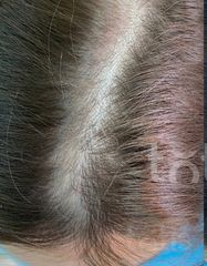 Результати Plinest Hair  фото до #1
