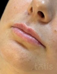Результати Saypha Filler Lidocaine NEW  фото до #1