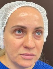 Результати Facetem S 1.5ml *1 шт. + конектор  фото до #1