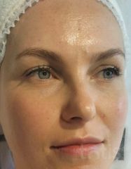 Результаты 450 Nutri'vital Eye Contour Cream  фото после #2