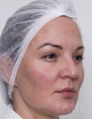Результаты Набор TESSLIFT SOFT V-DERM (10 нитей) + Бандаж + канюля SoftFil 18G 90mm + 18G*40mm игла  фото до #1