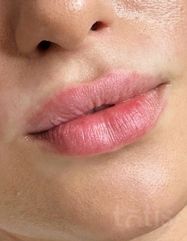 Результати Saypha Filler Lidocaine NEW  фото до #1
