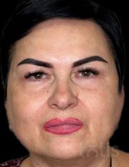 Rezultate Facetem S 0.8ml * 1 seringă  фото после #2