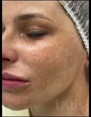 Výsledky Hydro-Marin® Serum  фото до #1
