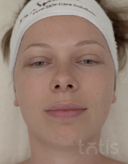 Результаты Celltresor Hydro-Release Fleece Mask  фото до #1