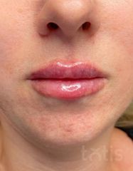 Результати Saypha Filler Lidocaine NEW  фото после #2