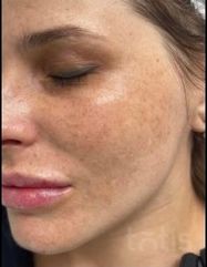 Výsledky Hydro-Marin® Serum  фото после #2