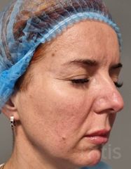 Результати Facetem S 1,5 ml  фото до #1