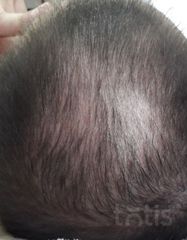 Rezultate Hair Restorer Xtra  фото после #2