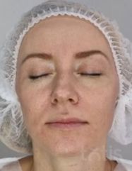 Rezultate Facetem S 0.8ml * 1 seringă  фото после #2