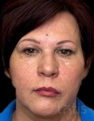 Výsledky Facetem S 0.8mlx2  фото после #2