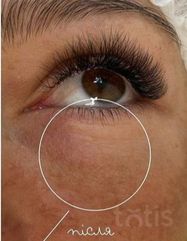 Результати Plinest Eye  фото после #2