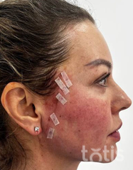 Rezultaty Zestaw TESSLIFT SOFT V-DERM (10 nici) + Bandaż + kaniula SoftFil 18G 70mm + igła 18G  фото после #2