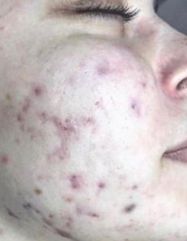 Rezultate SKIN RECOVERY  фото до #1