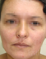 Результати 01 Me Line Caucasian Skin  фото после #2