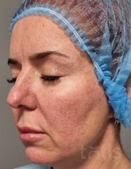 Rezultate Facetem S 0.8ml * 1 seringă  фото до #1