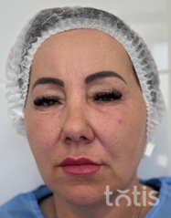 Rezultaty Zestaw TESSLIFT SOFT V-DERM (10 nici) + Bandaż + kaniula SoftFil 18G 70mm + igła 18G  фото до #1