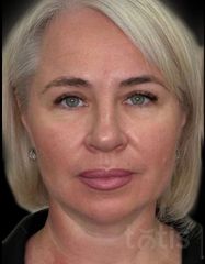 Результати Facetem S 1,5 ml  фото до #1