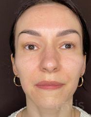 Rezultate Facetem S 0.8ml * 1 seringă  фото после #2
