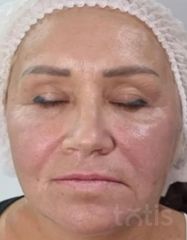 Rezultate Facetem S 0.8ml * 1 seringă  фото после #2