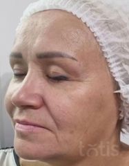 Результати Facetem S 1.5ml *1 шт. + конектор  фото до #1