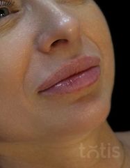 Результати Saypha Filler Lidocaine NEW  фото до #1