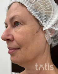 Rezultaty Zestaw TESSLIFT SOFT V-DERM (10 nici) + Bandaż + kaniula SoftFil 18G 70mm + igła 18G  фото до #1