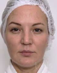 Результати Набір TESSLIFT SOFT V-DERM (10 ниток) + Бандаж + канюля SoftFil 18G 70mm + 18G*40mm голка  фото до #1