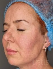 Rezultate Facetem S 0.8ml * 1 seringă  фото после #2