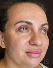 Результати 01 Me Line Caucasian Skin  фото после #2