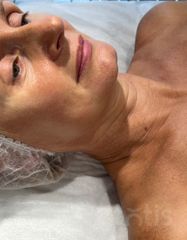 Результаты 650 Lift'Expert Wrinkle Smoother  фото до #1