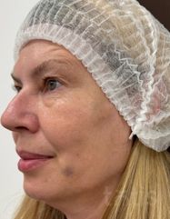 Результаты Набор TESSLIFT SOFT V-DERM (10 нитей) + Бандаж + канюля SoftFil 18G 90mm + 18G*40mm игла  фото после #2