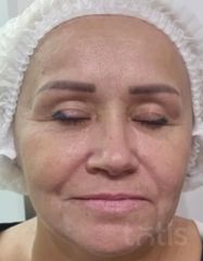 Rezultate Facetem S 0.8ml * 1 seringă  фото до #1
