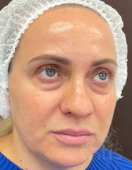 Результати Facetem S 1,5 ml  фото до #1
