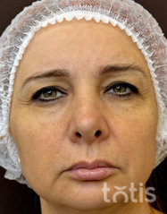 Rezultaty Zestaw TESSLIFT SOFT V-DERM (10 nici) + Bandaż + kaniula SoftFil 18G 70mm + igła 18G  фото после #2