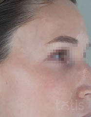 Результати 01 Me Line Caucasian Skin  фото после #2