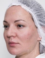 Результаты Набор TESSLIFT SOFT V-DERM (10 нитей) + Бандаж + канюля SoftFil 18G 90mm + 18G*40mm игла  фото до #1