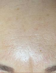 Результати AGE RESCUE 24H CREAM  фото после #2