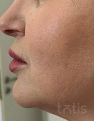 Результаты Набор TESSLIFT SOFT V-DERM (10 нитей) + Бандаж + канюля SoftFil 18G 90mm + 18G*40mm игла  фото после #2